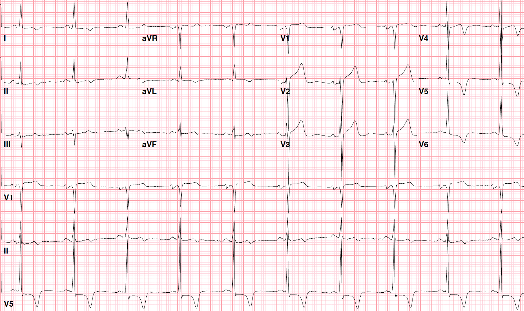 abnormal 12 lead ecg